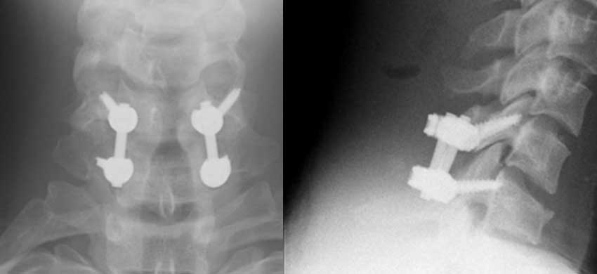 Cervical Laminectomy +/- Fusion
