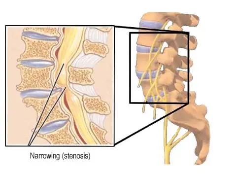 Posterior Spinal Decompression Surgery for Spinal Stenosis